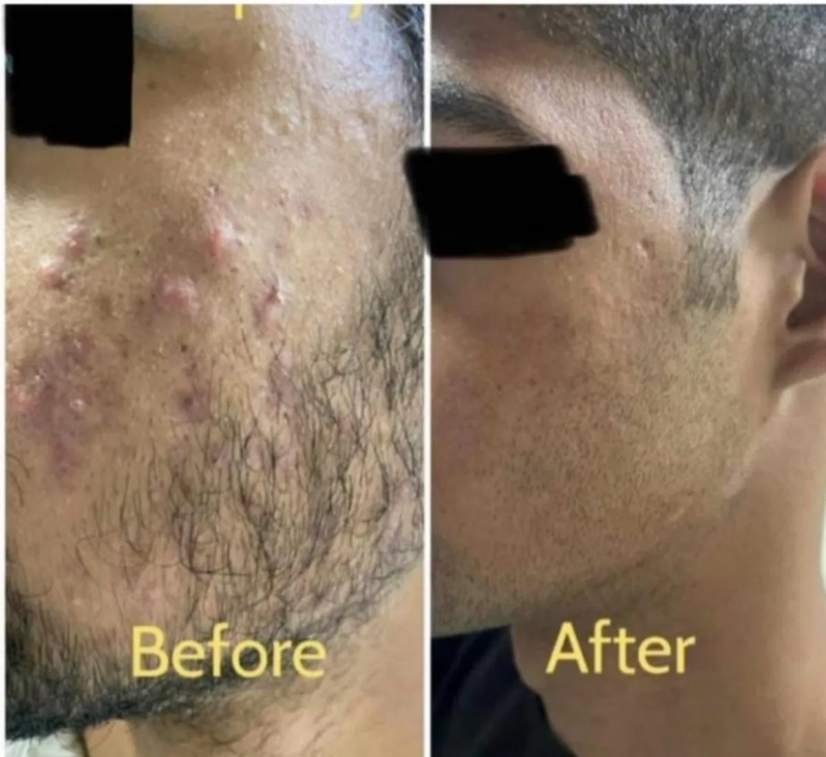 Acne treatment at Dr. Tupe's Clinic