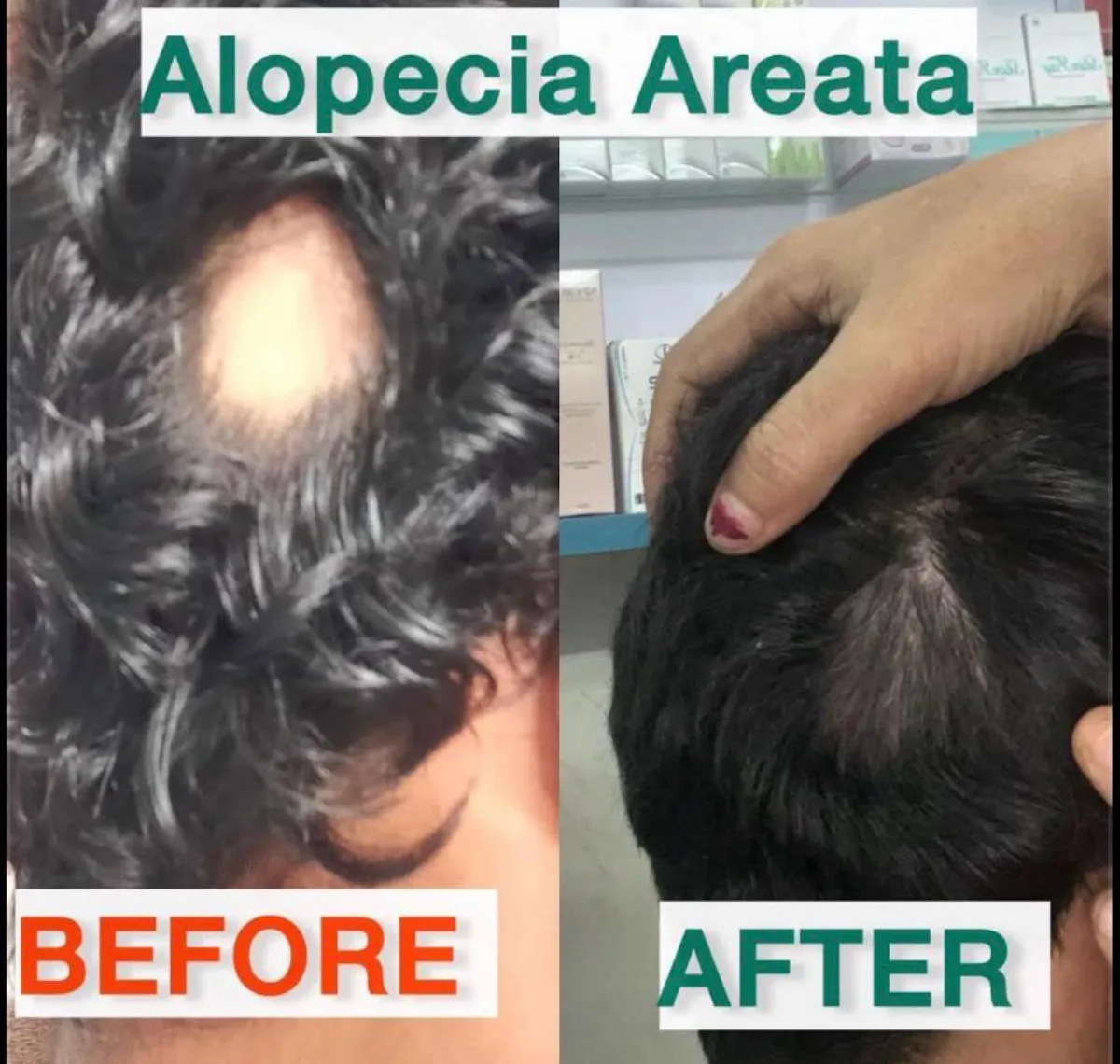 Alopecia areata treatment at Dr. Tupe's Clinic