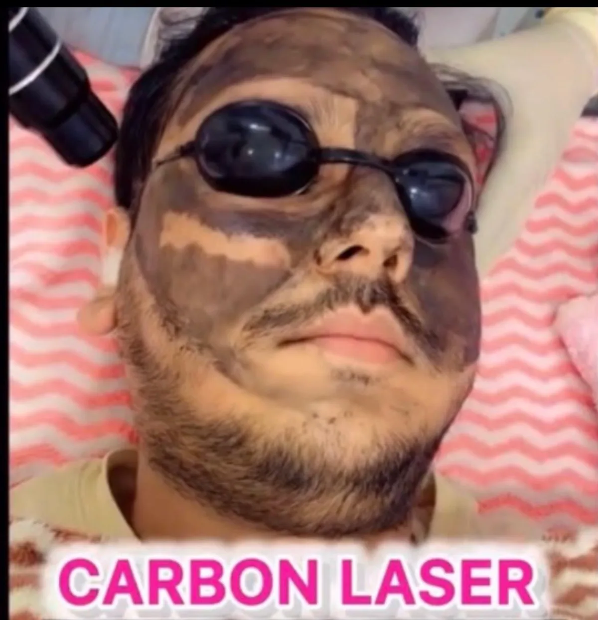 Carbon laser peel at Dr. Tupe's Clinic