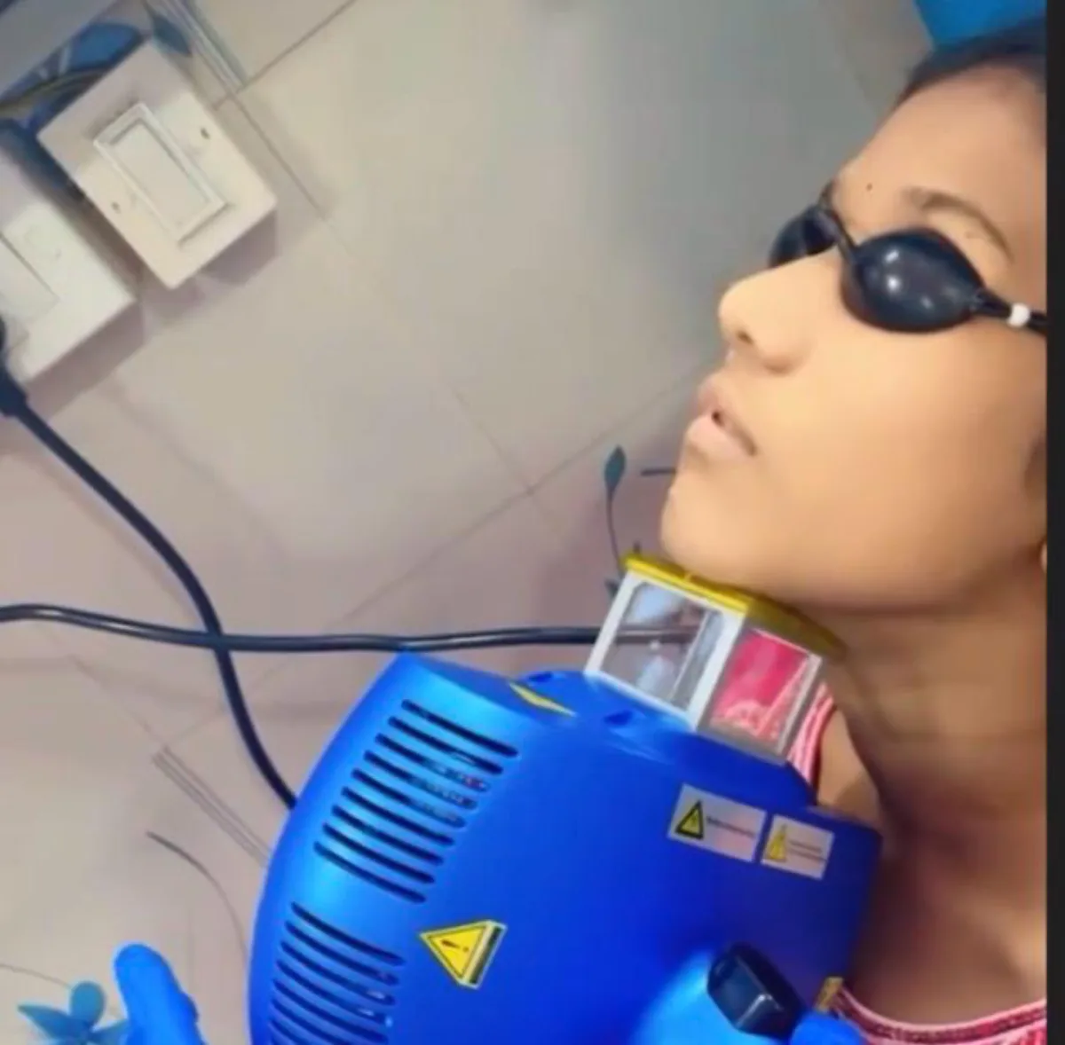 Excimer laser treatment at Dr. Tupe's Clinic