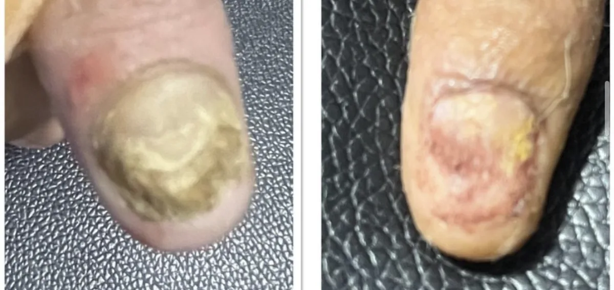 Fungal infection treatment at Dr. Tupe's Clinic