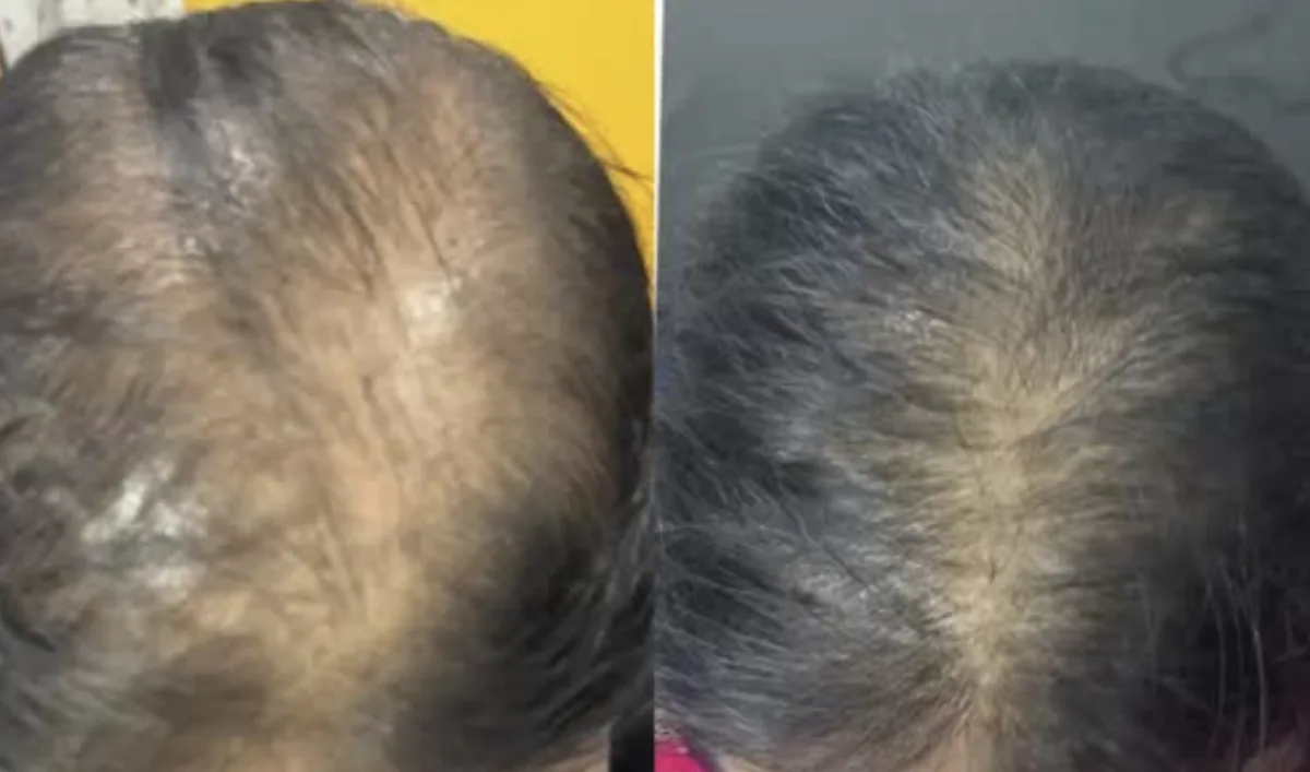 GFC (Growth Factor Concentrate) hair treatment at Dr. Tupe's Clinic