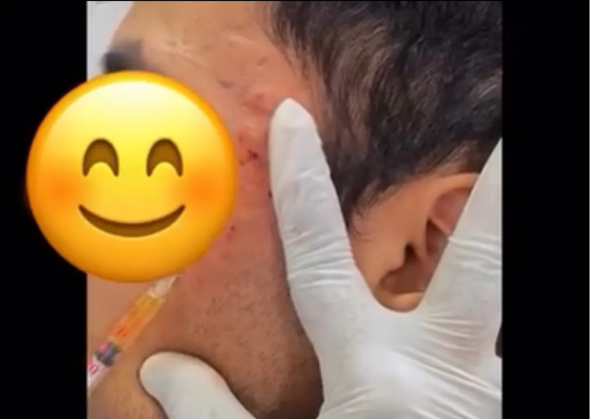 MNRF at Dr. Tupe's Clinic