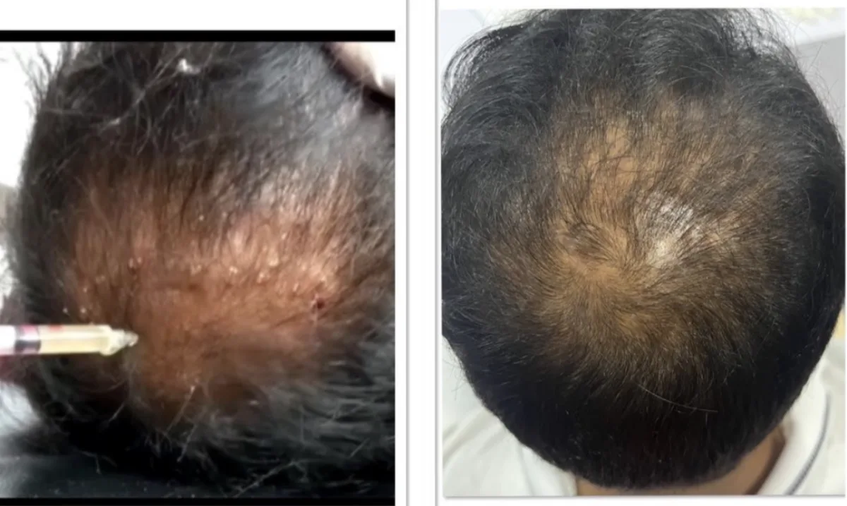 Hair mesotherapy at Dr. Tupe's Clinic