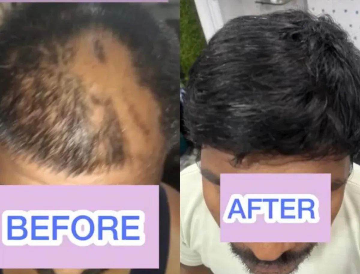 Hair loss management at Dr. Tupe's Clinic