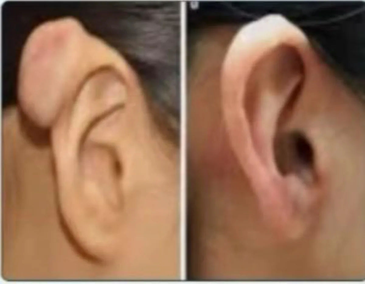 Keloid cryotherapy at Dr. Tupe's Clinic