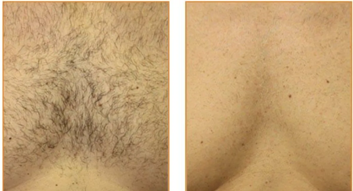 Laser hair reduction at Dr. Tupe's Clinic