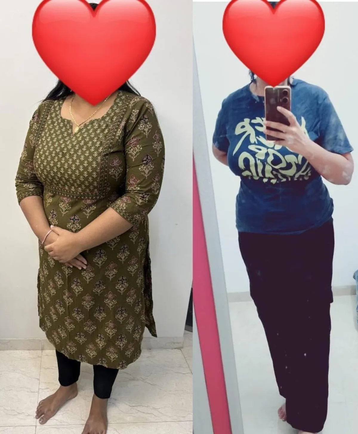 Laser lipolysis at Dr. Tupe's Clinic