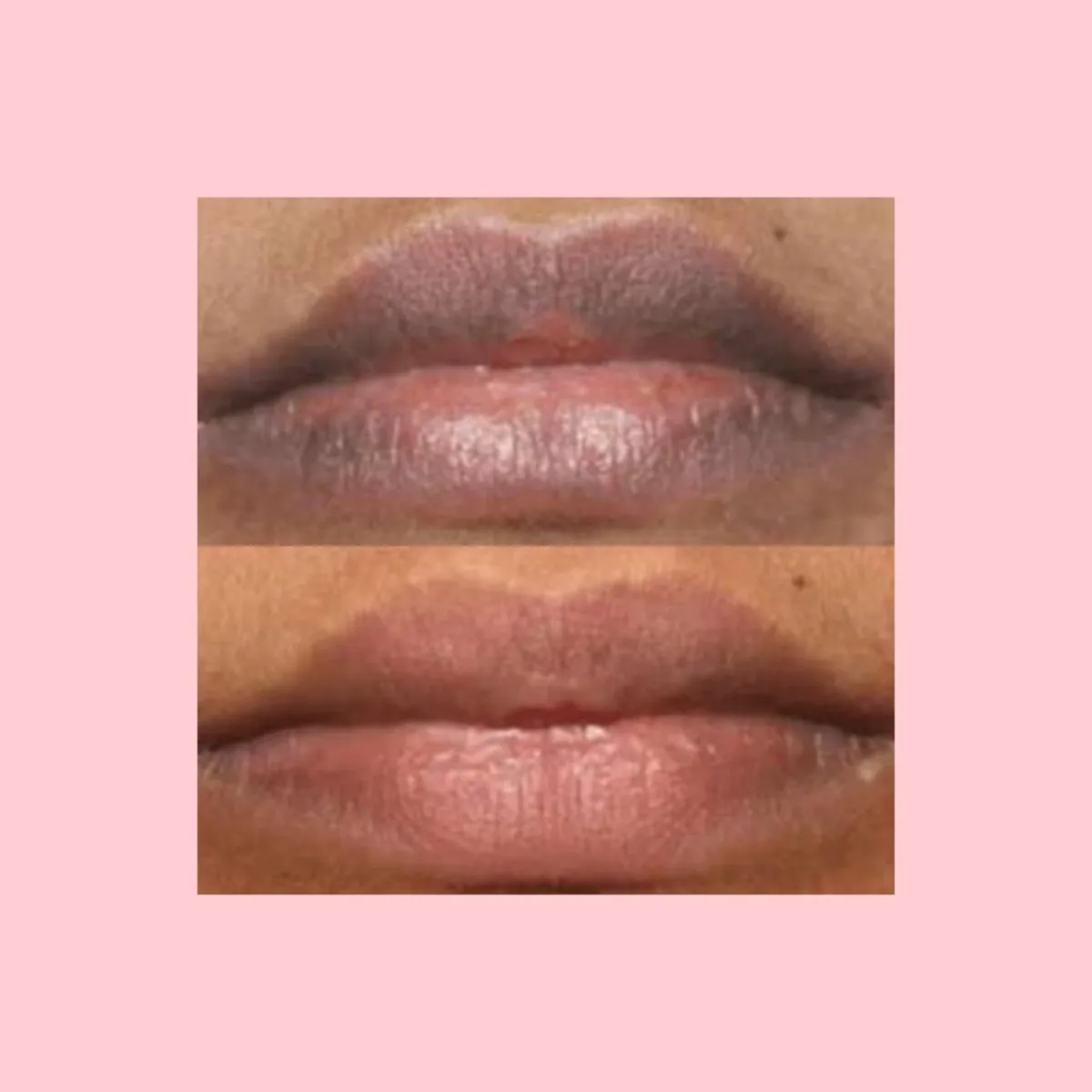 Lip lightening at Dr. Tupe's Clinic