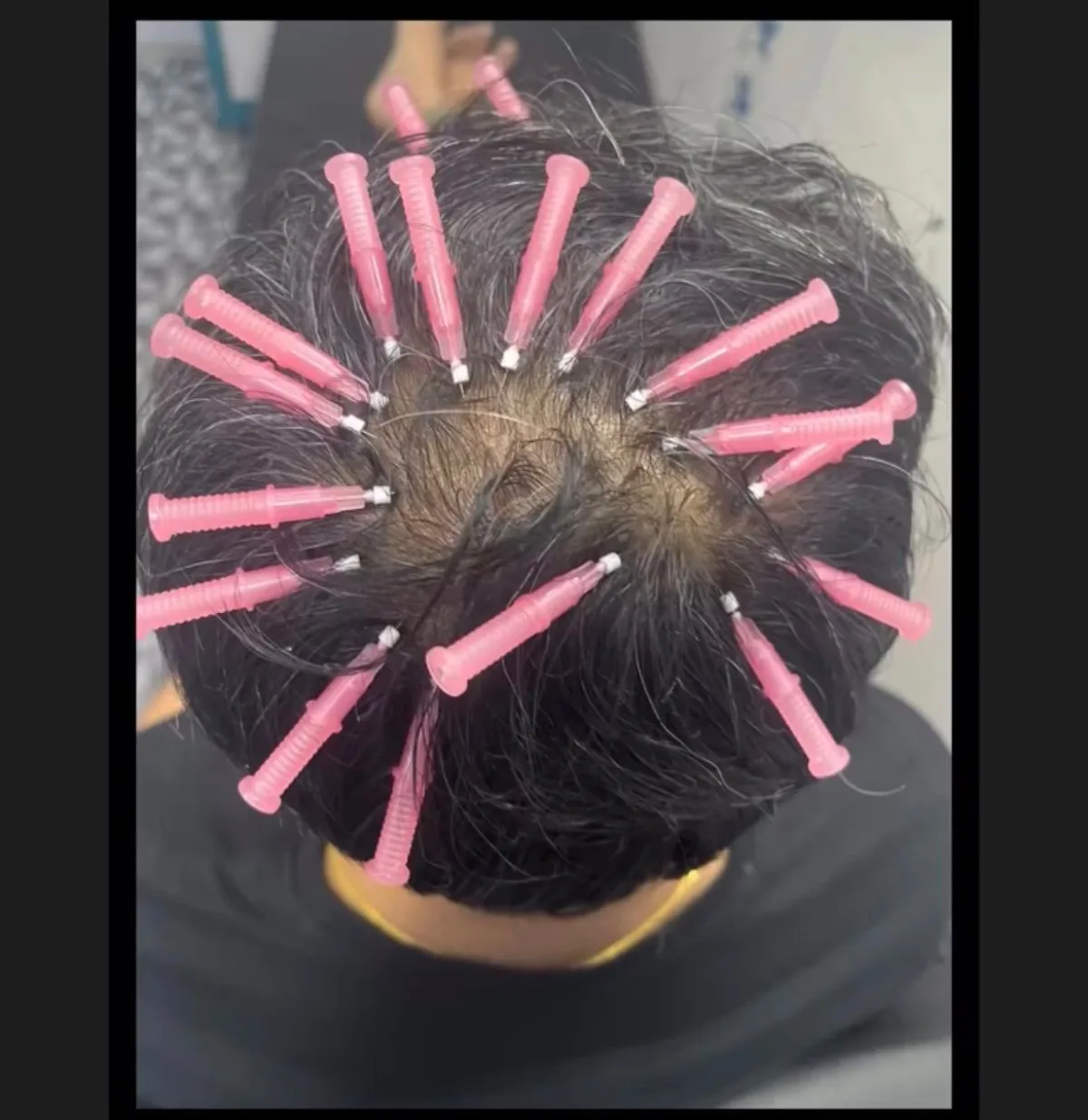 Laser hair reduction at Dr. Tupe's Clinic