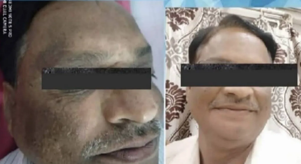 Pigmentation treatment at Dr. Tupe's Clinic