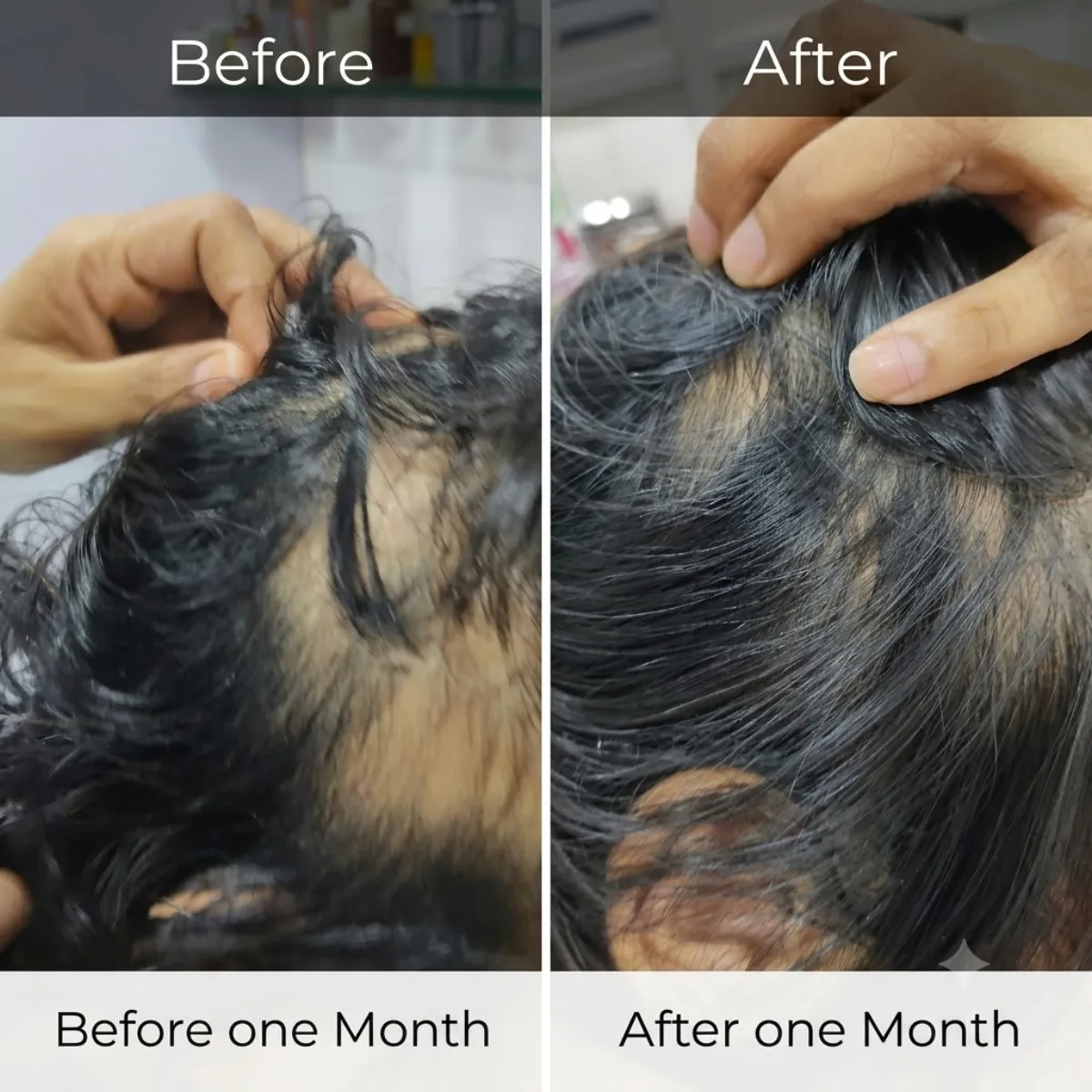 PRP (Platelet-rich plasma) hair treatment at Dr. Tupe's Clinic