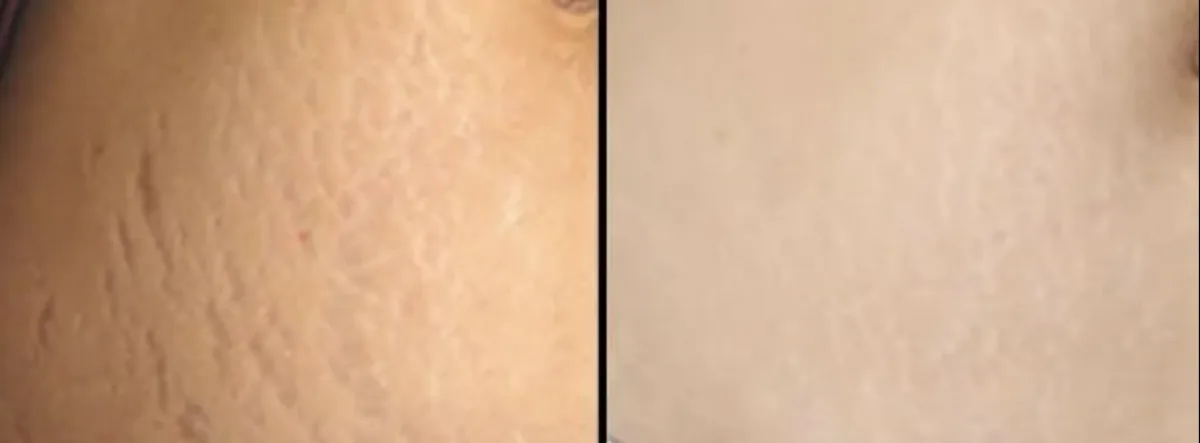 Stretchmarks removal at Dr. Tupe's Clinic
