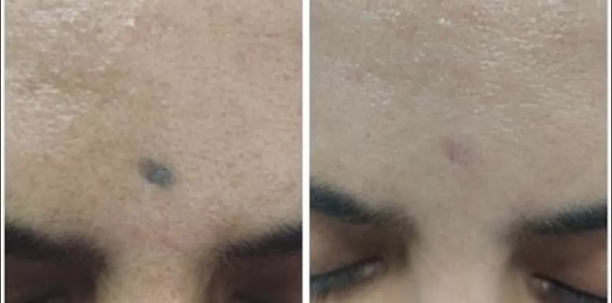 Tattoo Removal at Dr. Tupe's Clinic