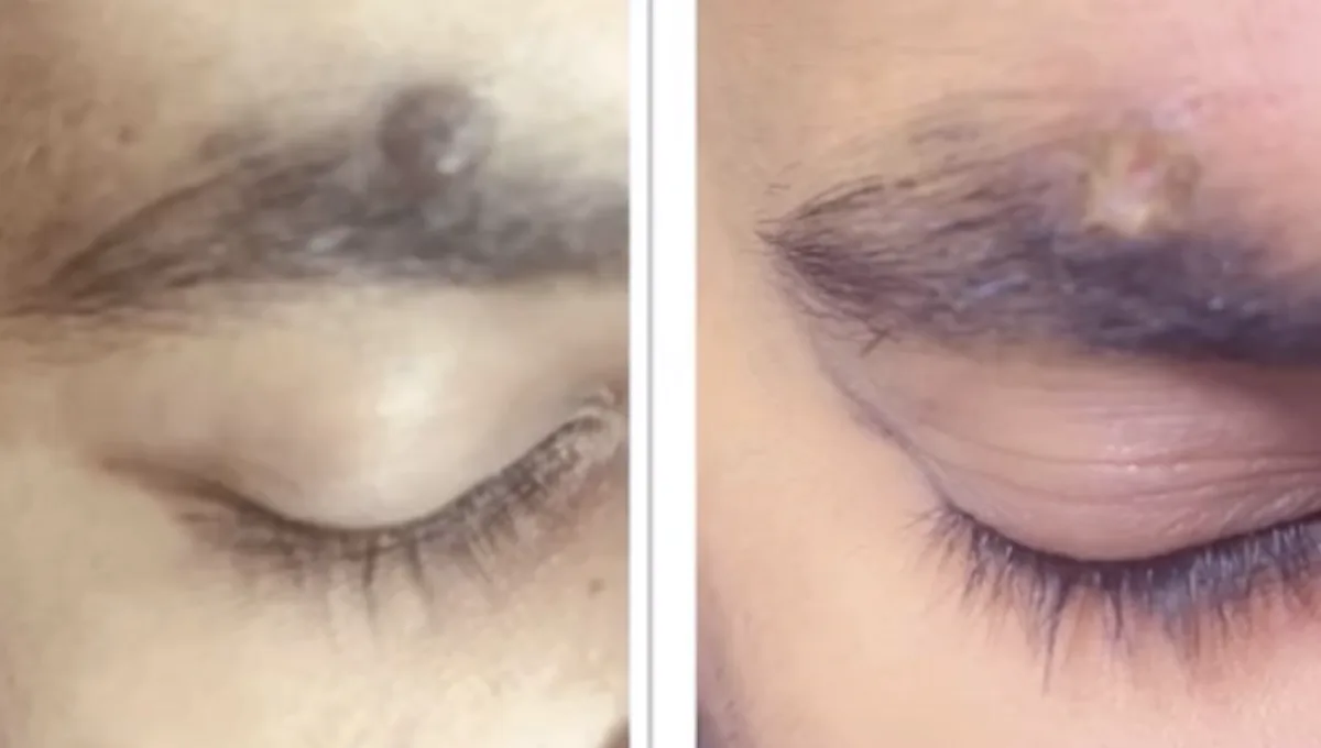 Mole and wart removal at Dr. Tupe's Clinic
