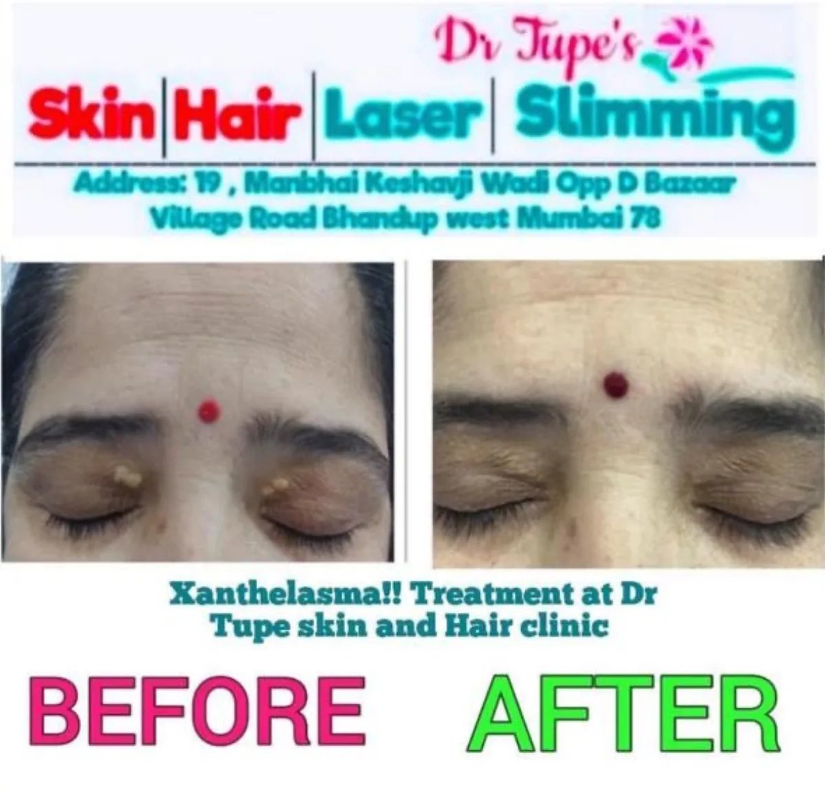 Xanthelasma removal at Dr. Tupe's Clinic